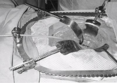 Bihrle Foley Catheter Cleat  